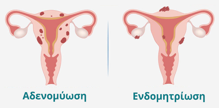 Adenomyosis What Is