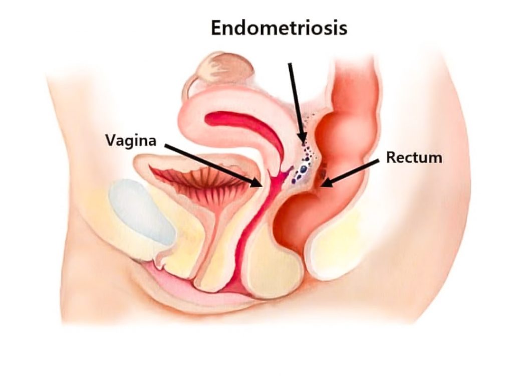 Endometriosis of the bowel - Ενδομητρίωση - Dr. Κυριακόπουλος